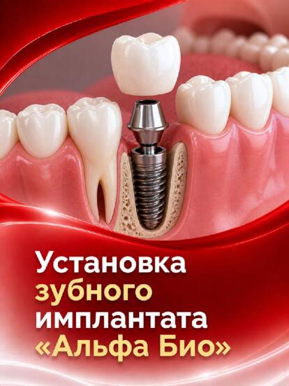 Установка зубного имплантата «Альфа Био» (Израиль)  